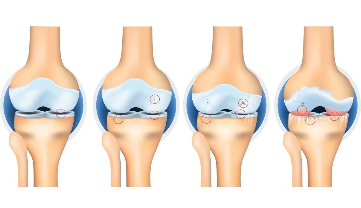 Arthrose der Gelenke